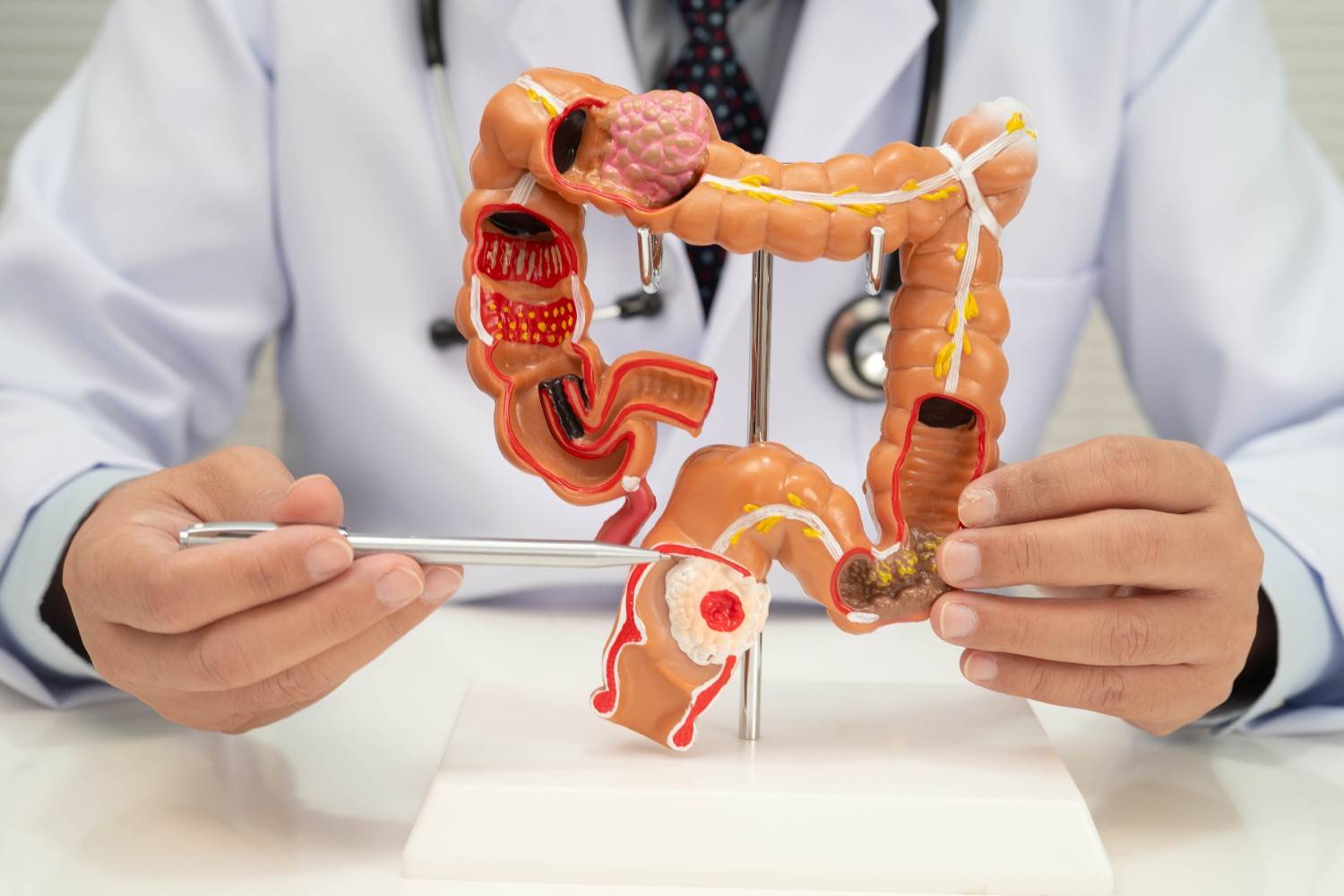 Expert Colon Cancer Surgery