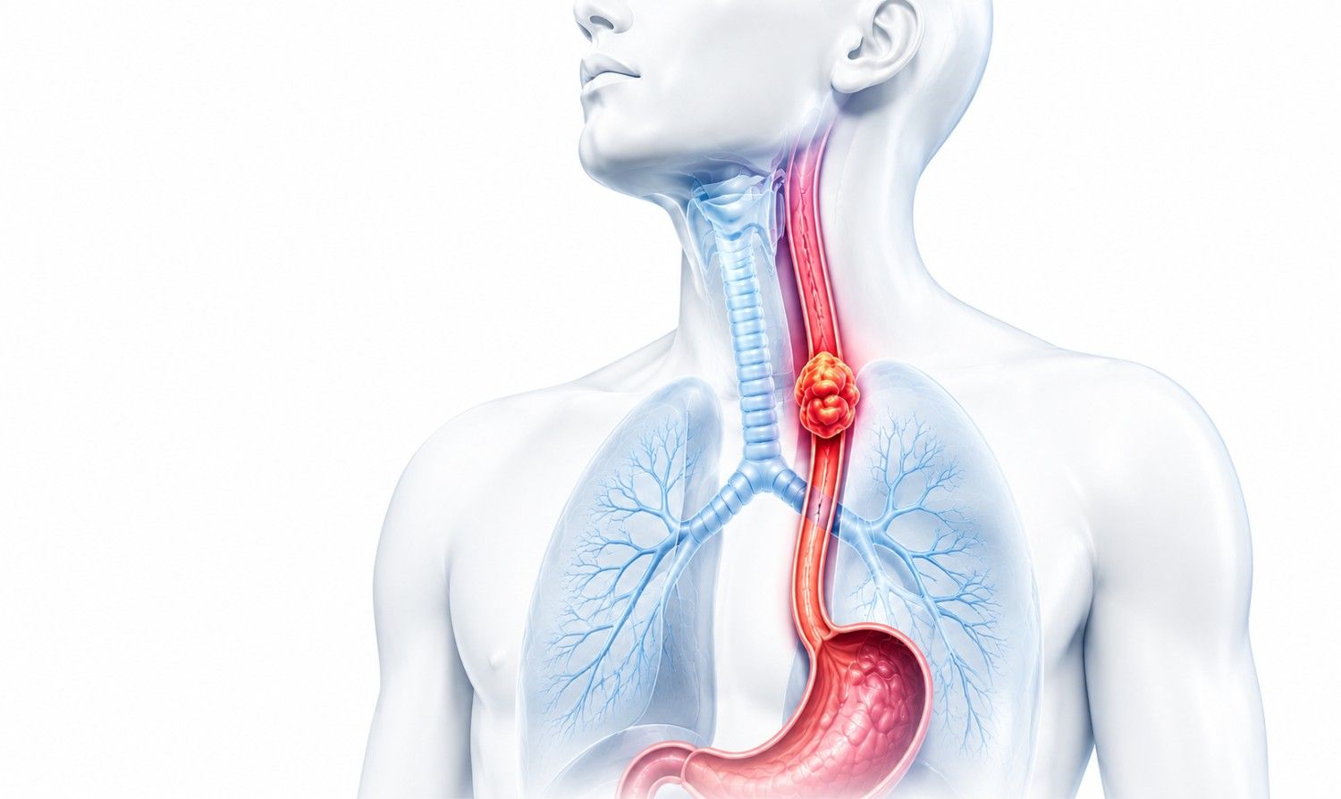 Esophagus Cancer Surgery in West Delhi