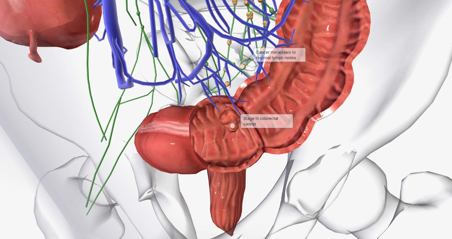 Rectum Cancer Surgeon in West Delhi